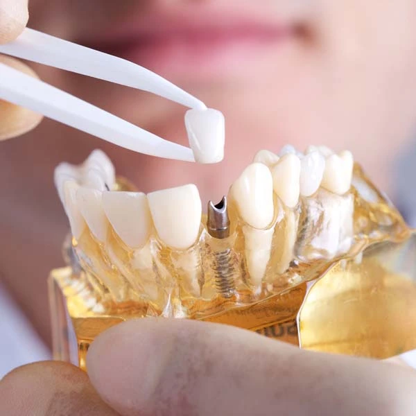 Soins Dentaires Compréhensifs - clinique dentaire tetouan maroc