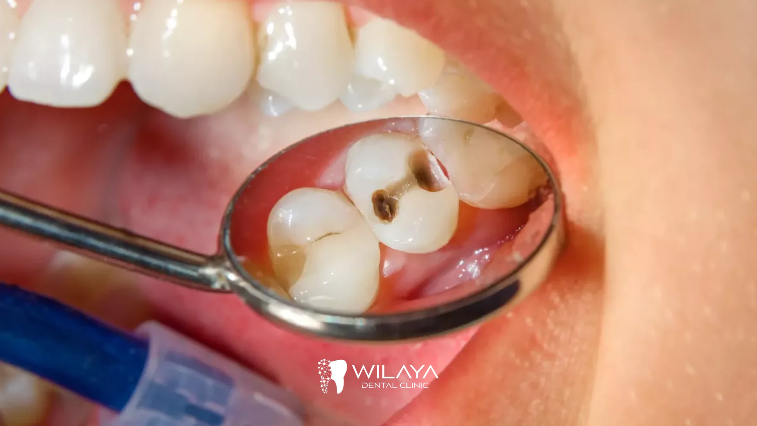 Prévention des Caries : Alimentation, Fluorure et Conseils Pratiques-wilaya-dental-clinic-tetouan-maroc-02
