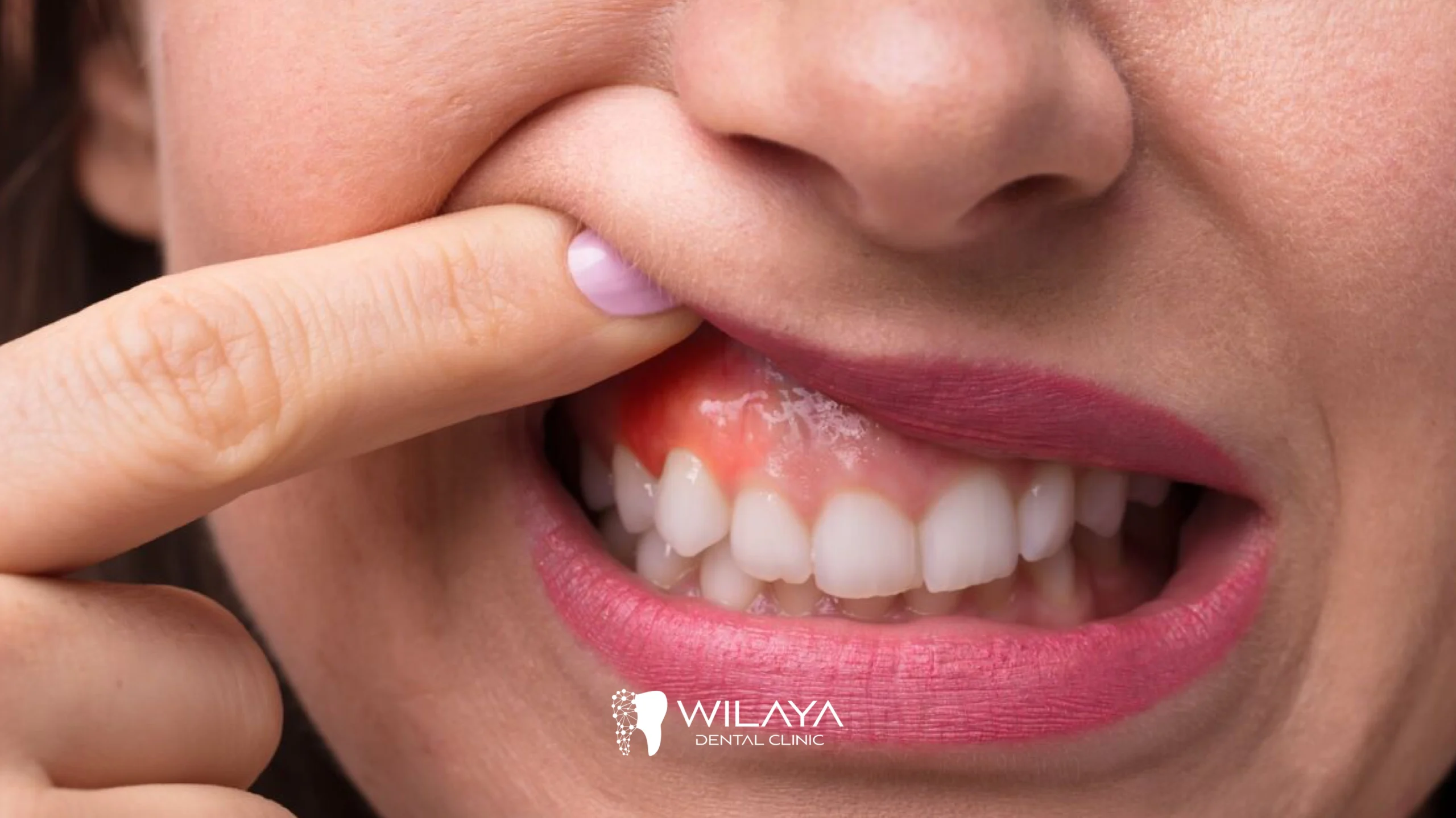 la Maladie Parodontale-wilaya-dental-clinic-tetouan-maroc-03