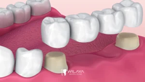 Maîtriser les Soins Prothétiques Dentaires