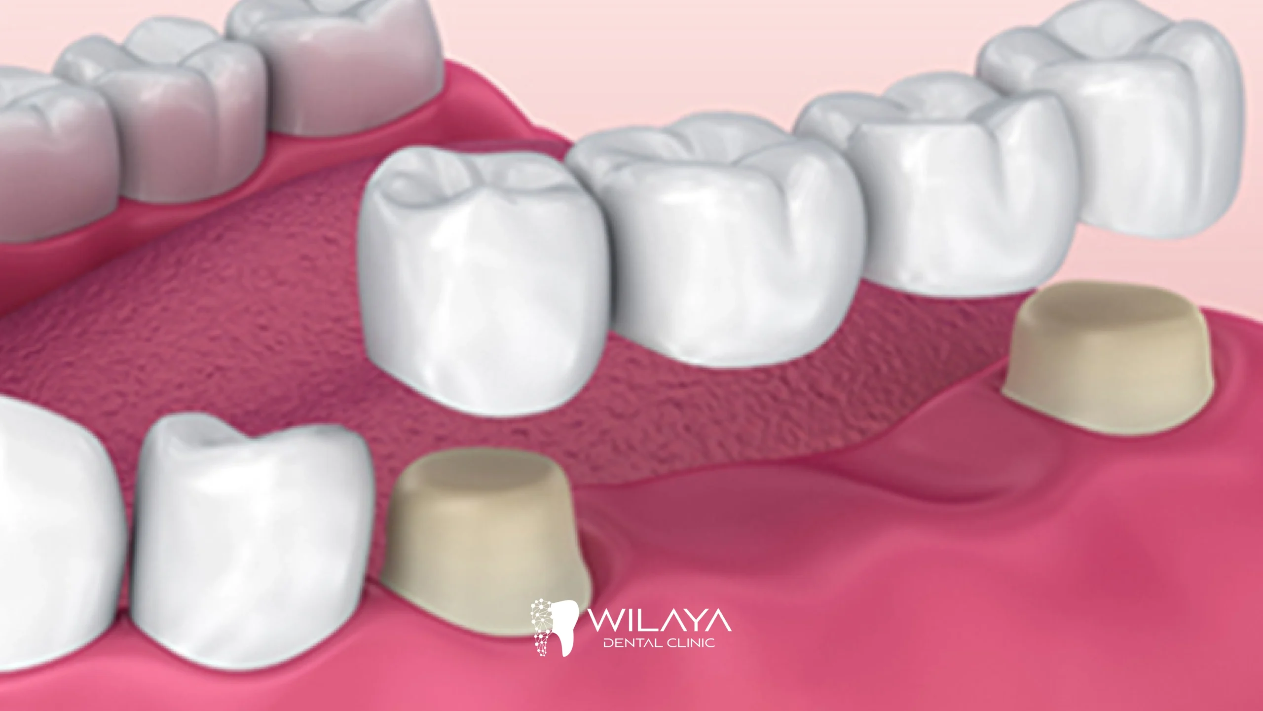 Maîtriser les Soins Prothétiques Dentaires